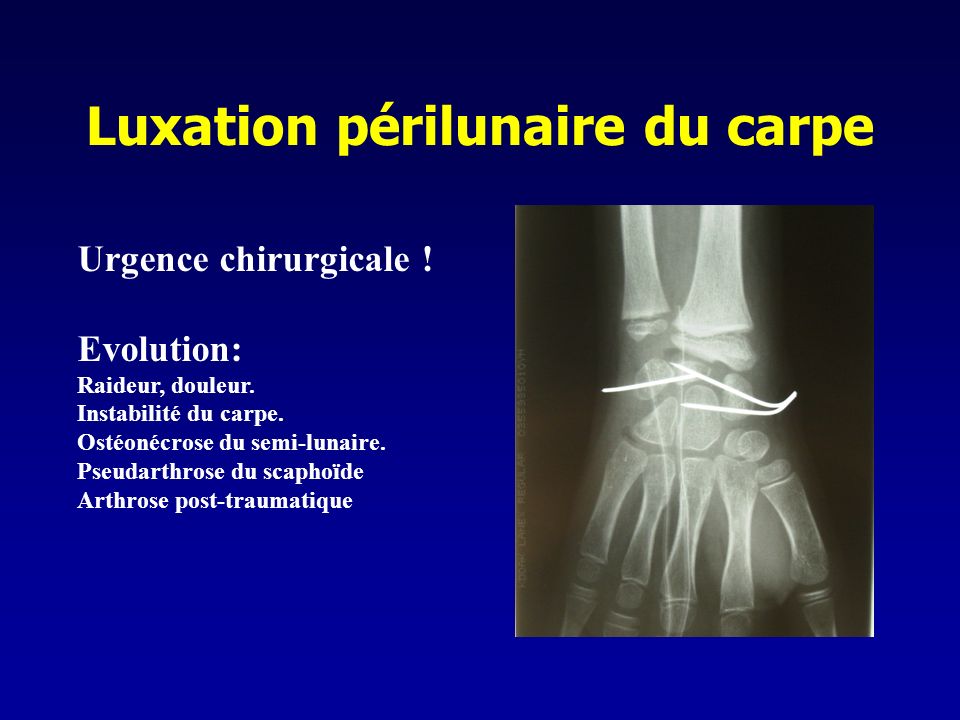 Traumatismes du poignet CCA Service chirurgie orthopédique ppt